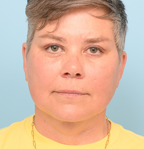 Face Lift/Neck Lift