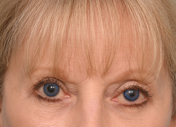 Brow Lift