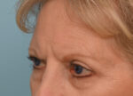 Brow Lift