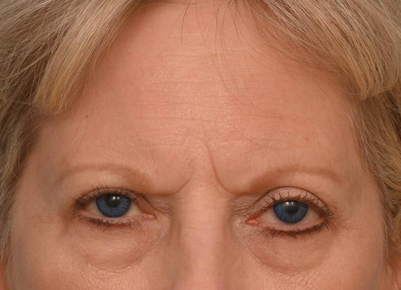 Brow Lift
