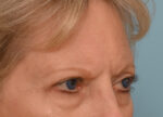 Brow Lift