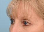 Brow Lift