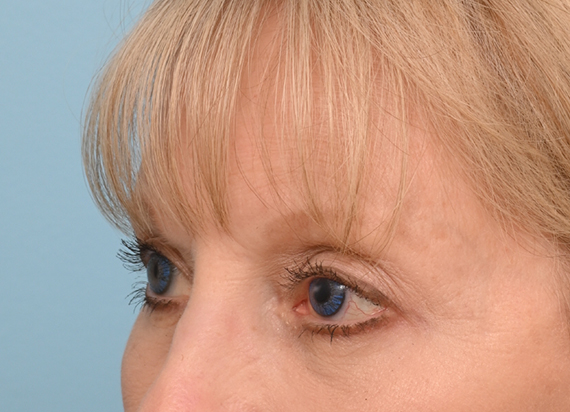Brow Lift