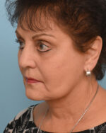 Face Lift/Neck Lift