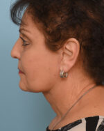 Face Lift/Neck Lift