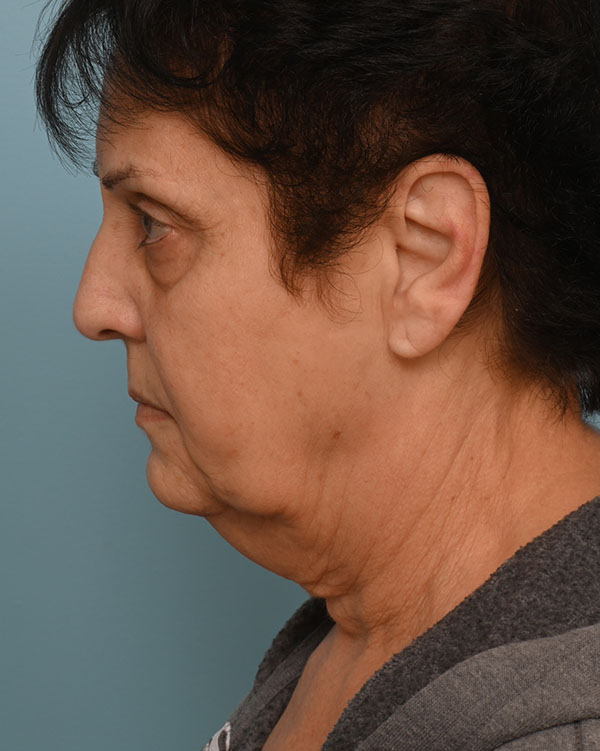 Face Lift/Neck Lift