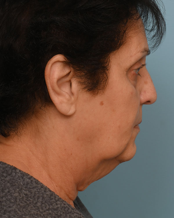 Face Lift/Neck Lift
