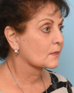 Face Lift/Neck Lift