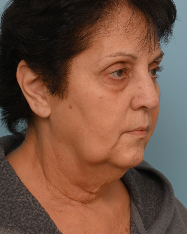 Face Lift/Neck Lift