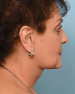 Face Lift/Neck Lift
