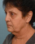 Face Lift/Neck Lift