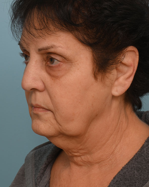 Face Lift/Neck Lift