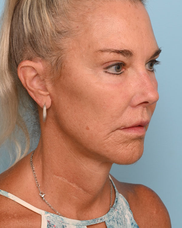 Face Lift/Neck Lift