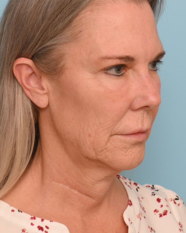 Face Lift/Neck Lift