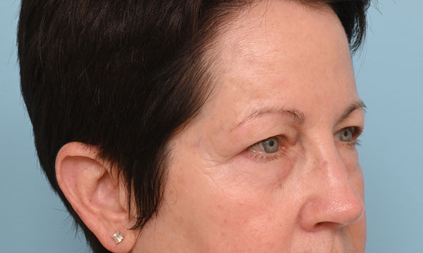 Eye Rejuvenation