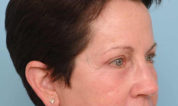 Eye Rejuvenation