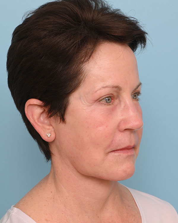 Facial Fat Transfer