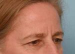 Brow Lift