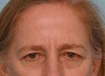 Brow Lift