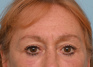 Brow Lift