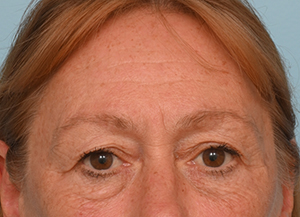 Brow Lift
