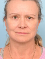 Face Lift/Neck Lift