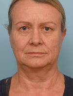 Face Lift/Neck Lift
