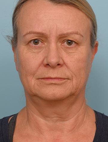 Face Lift/Neck Lift