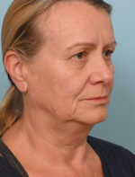 Face Lift/Neck Lift