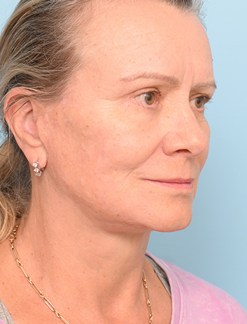Face Lift/Neck Lift