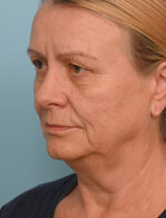 Face Lift/Neck Lift