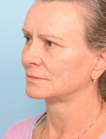 Face Lift/Neck Lift
