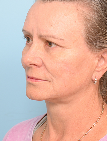 Face Lift/Neck Lift