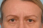 Brow Lift