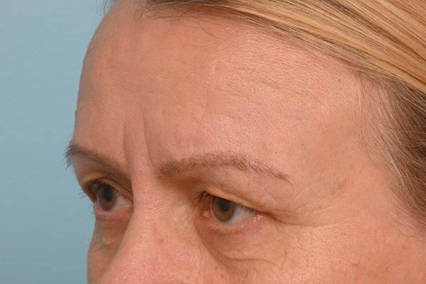 Brow Lift