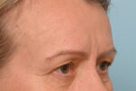 Brow Lift