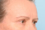 Brow Lift
