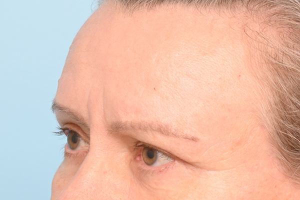 Brow Lift