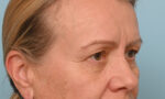 Eye Rejuvenation