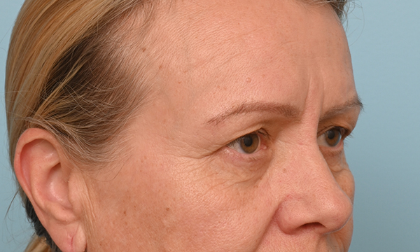 Eye Rejuvenation