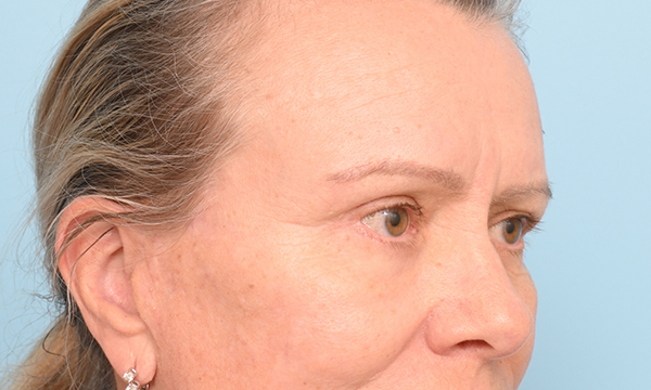Eye Rejuvenation