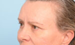 Eye Rejuvenation