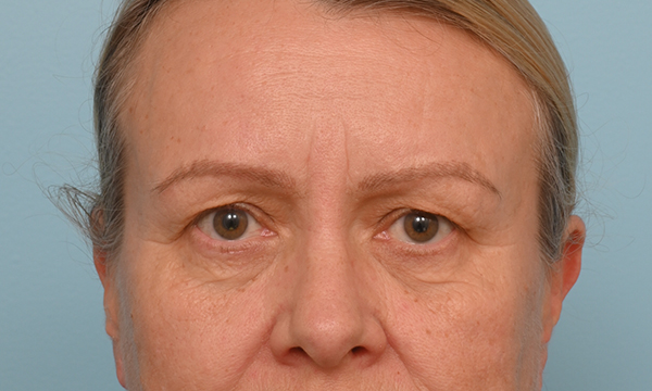 Eye Rejuvenation