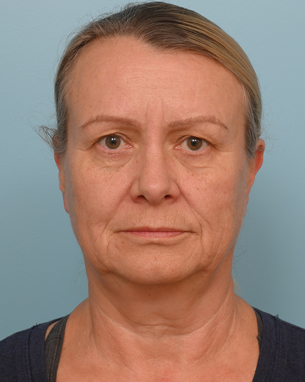 Facial Fat Transfer