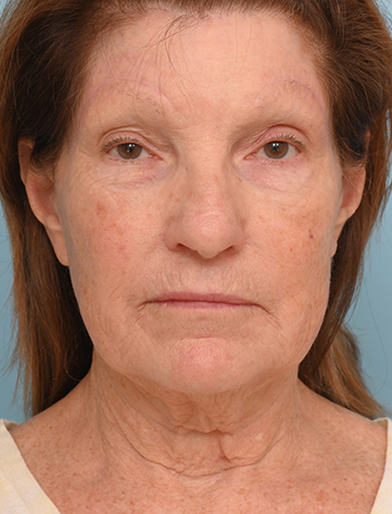 Face Lift/Neck Lift