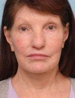Face Lift/Neck Lift
