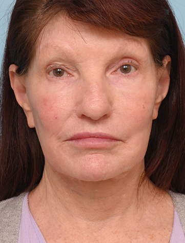 Face Lift/Neck Lift