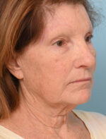 Face Lift/Neck Lift