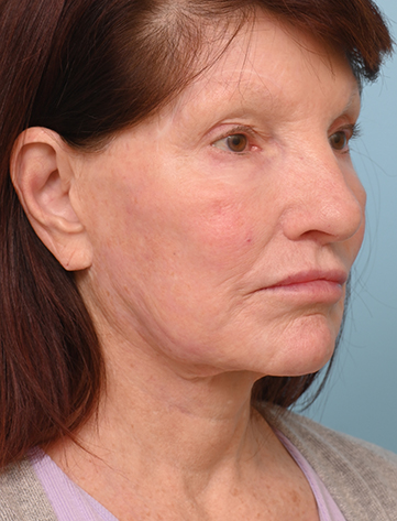 Face Lift/Neck Lift