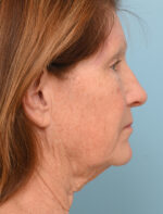 Face Lift/Neck Lift